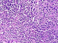 基底细胞癌的类型有哪些？
