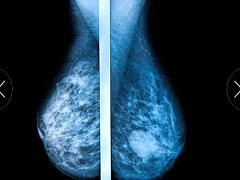 帕博西尼能够联合治疗晚期乳腺癌