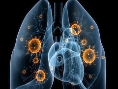 凡德他尼是否能够有效控制非小细胞肺癌
