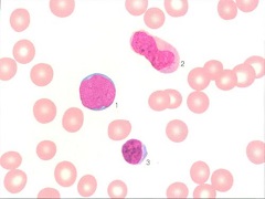 急性淋巴细胞白血病（ALL）可用calaspargase pegol-mknl治疗