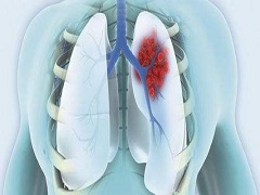 阿特珠单抗联合治疗小细胞肺癌的疗效如何？
