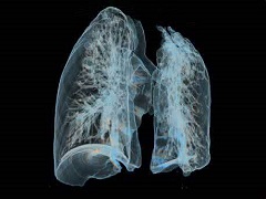 艾乐替尼能够大幅提高肺癌患者的生存时间