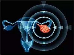 奥拉帕尼单药治疗晚期卵巢癌