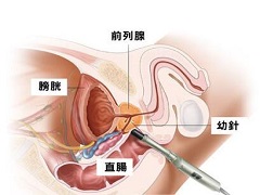 恩杂鲁胺的副作用和价格 