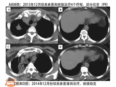 克唑替尼一盒多少钱？