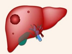 乐伐替尼对肝癌疗效显著