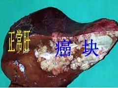 索拉非尼的药物相互作用