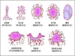 凡德他尼能够治疗晚期乳腺癌吗？