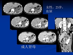 为什么印度阿西替尼更受欢迎