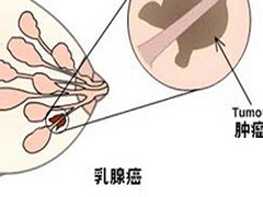 来那替尼联合T-DM1治疗HER2阳性乳腺癌ORR为60%