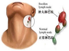 如何处理依鲁替尼引发的出血和淋巴细胞增多？