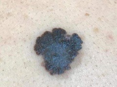 FDA批准达拉非尼联合用于术后辅助治疗