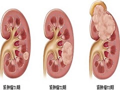 患者应该对阿西替尼副作用做好预防