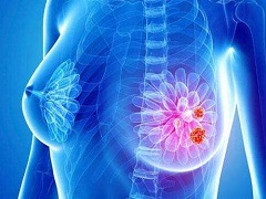 Herceptin Hylecta为最新上市的乳腺癌药物