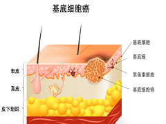 基底细胞癌的治疗药物是伊曲康唑 基底细胞癌 海得康海外医疗