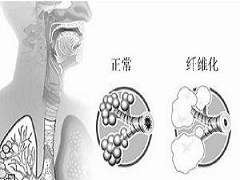 尼达尼布的使用详解