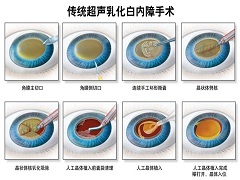 白内障最有效的治疗方法