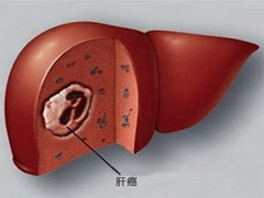 海外就医：肝癌晚期的症状是什么？