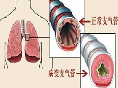 支气管炎和肺炎有哪些区别