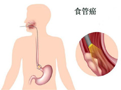 食道癌治疗记